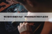 钢钉板切尔西图片大全？ 钢板拆掉后的钉眼多久能长好？